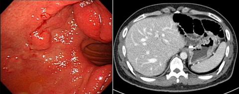 Local tumor recurrence