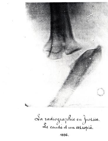 estropié