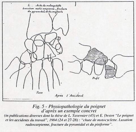 poignet
