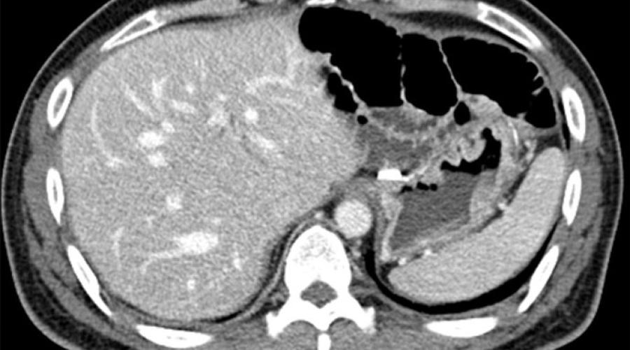 Local tumor recurrence