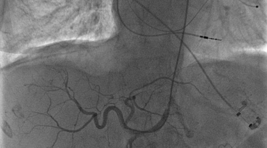 de chimioembolisation d’un carcinome hépatocellulaire